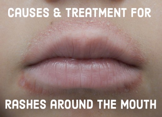 Perioral Dermatitis or Periorificial Dermatitis - Sclero