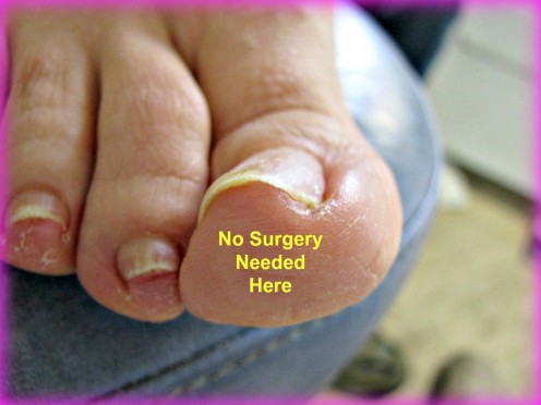 How to Avoid Ingrown Toenail Surgery How to Avoid Ingrown Toenail Surgery