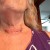 A week after surgery A week after surgery