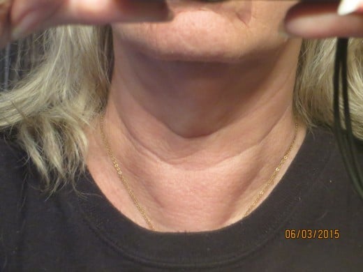 Thyroidectomy - My Experience | HubPages