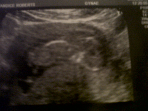 Baby scan at three months pregnant
