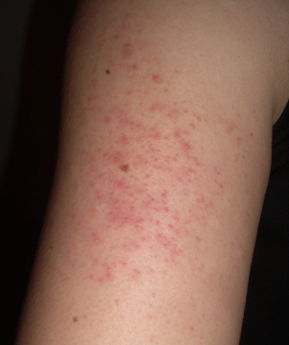 Albums 98+ Images photos of rashes on legs Sharp