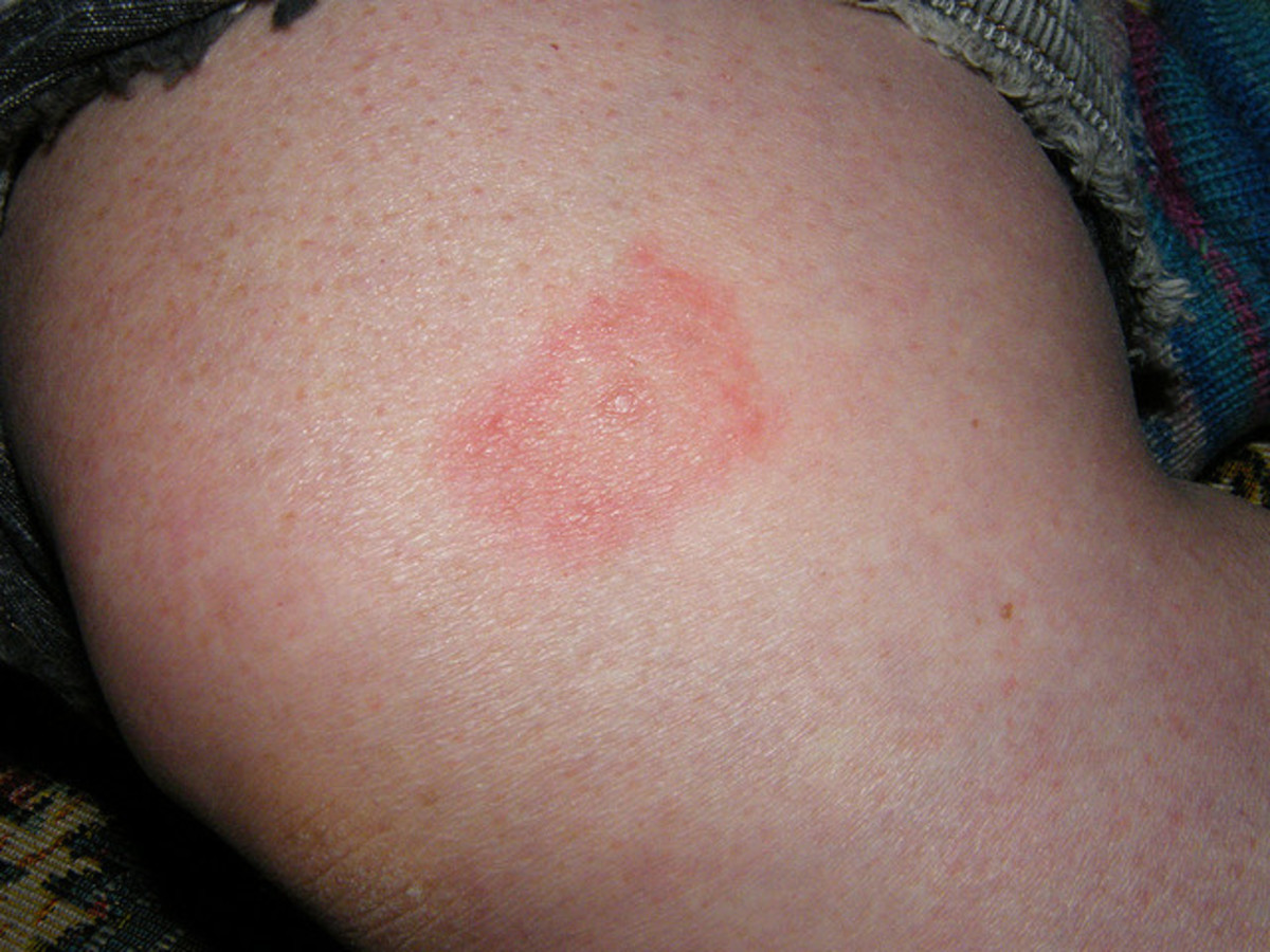 Tick bites can be very serious, in that they can transmit diseases for which there are only treatments for symptoms, but no cure.