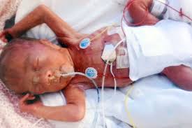 Preemie Born at 24 Weeks