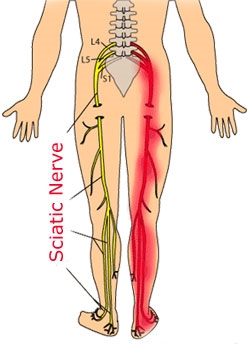 Sciatica: Lower back pain radiating down a leg 