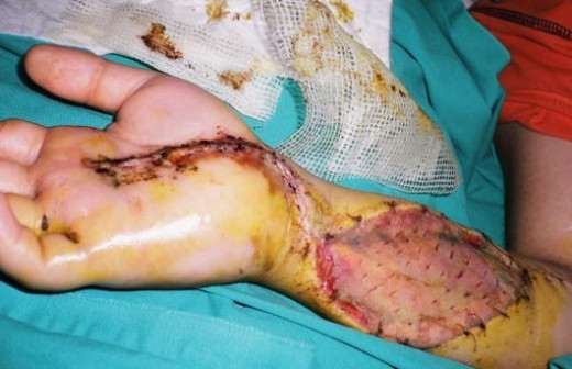Showing horrendous and life-altering necrosis resulting from Puff Adder bite.  
