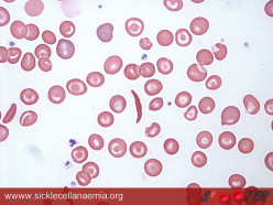 Overview of Iron Deficiency Anaemia