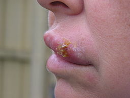 Cold sores virus can be spread through salva excahnge