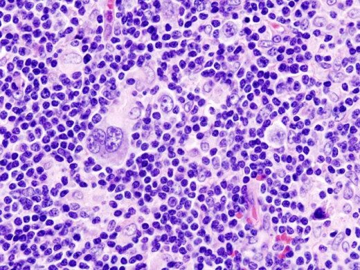 The mixed cellularity type along with the sinus tumor gave the initial diagnosis as non Hodgkin's Lymphoma.