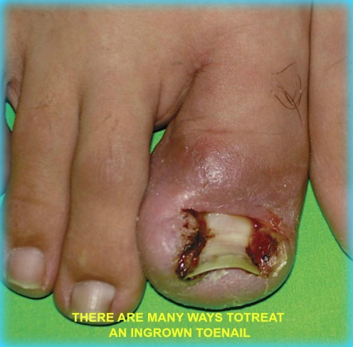 Ingrown Toenail Treatments Can Vary Significantly Ingrown Toenail Treatments Can Vary Significantly