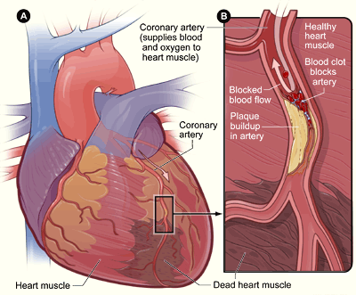 Accumulation of cholesterol in arteries causes heart attack