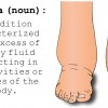 Complications Related to Chronic Weeping Edema of the Lower Extremities