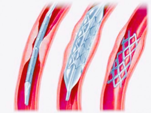 Stent Placement in a Plaque filled Coronary artery.