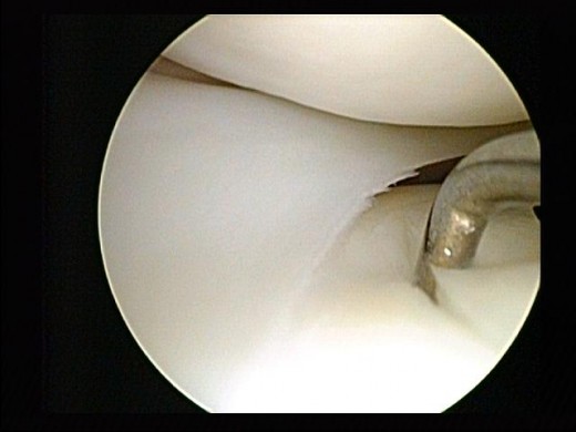 Lateral meniscus located between thigh bone and shin bone.