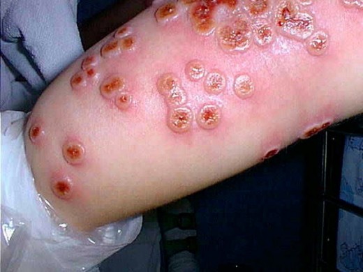 Cowpox - Wikipedia
