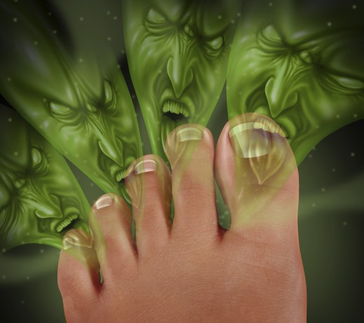 *Not an accurate representation of toenail fungus.