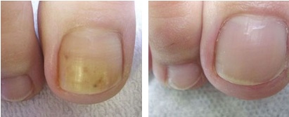 One of the less disturbing photos of actual nail fungus out there.