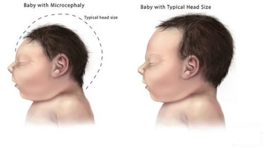 Effects of Microcephaly Caused By Zika Virus