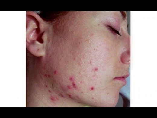 Dry Skin And Acne - What Acne Treatment To Use And How To Manage It