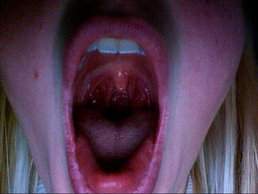 I love my tonsils. Why are they so sore?
