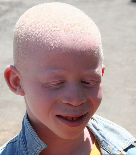 Person living with Albinism (An Albino)
