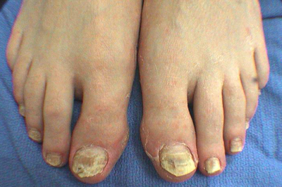 Advanced stage of toenail fungus