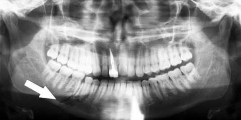 Panoramic radiograph of human teeth from Wikipedia