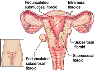 Location of different uterine fibroids