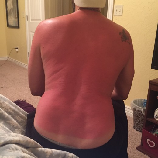 My illustrious sunburn - in April