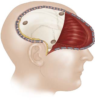 Trauma Flap 12-4