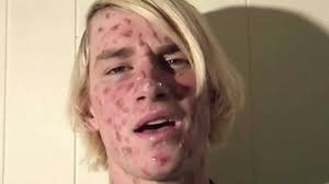 Recurring Acne