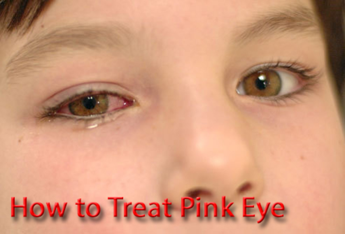 How to Treat Pink Eye (With Photos) HubPages