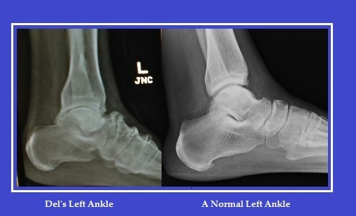 My left ankle compared to a normal ankle. Note the bone spurs on top and the lack of space between the joints and foot bones.