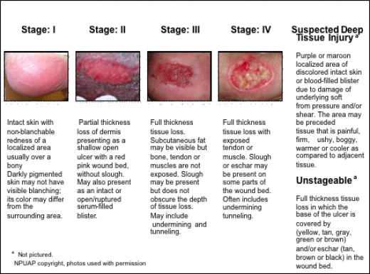 how-to-prevent-diabetic-ulcers-hubpages