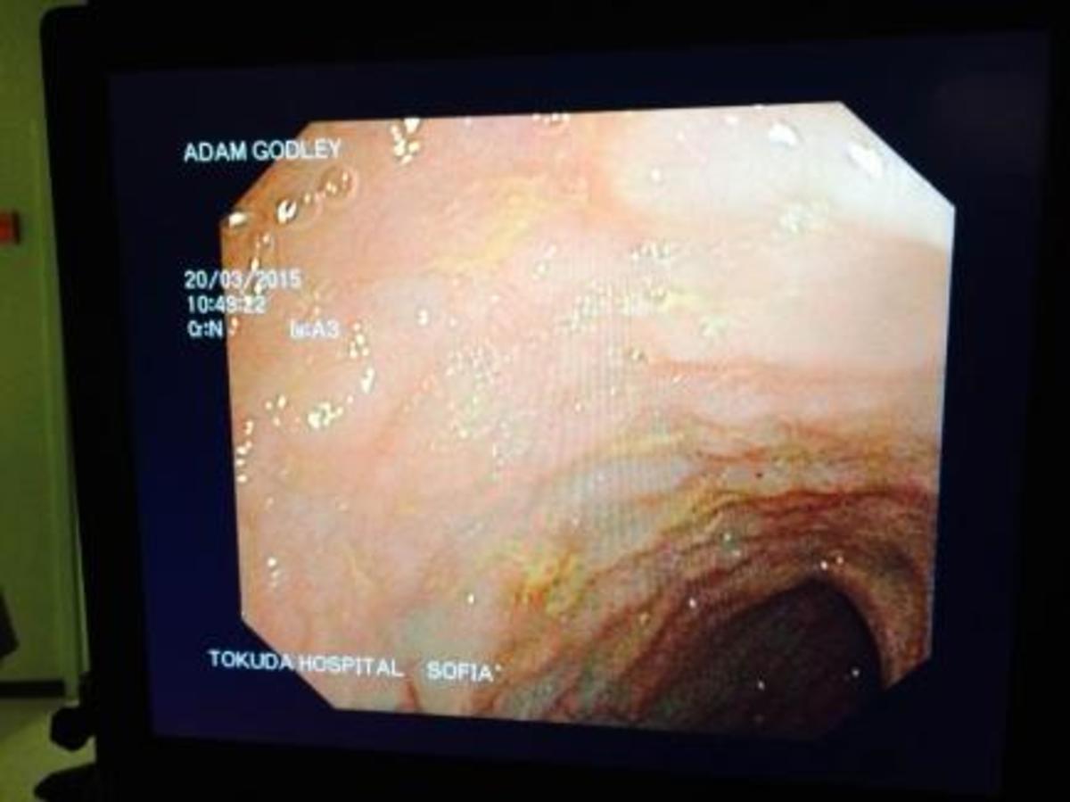 Pillcam image of my son's diseased terminal ileum 