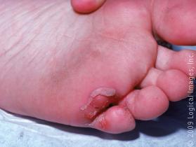 Athletes foot infection