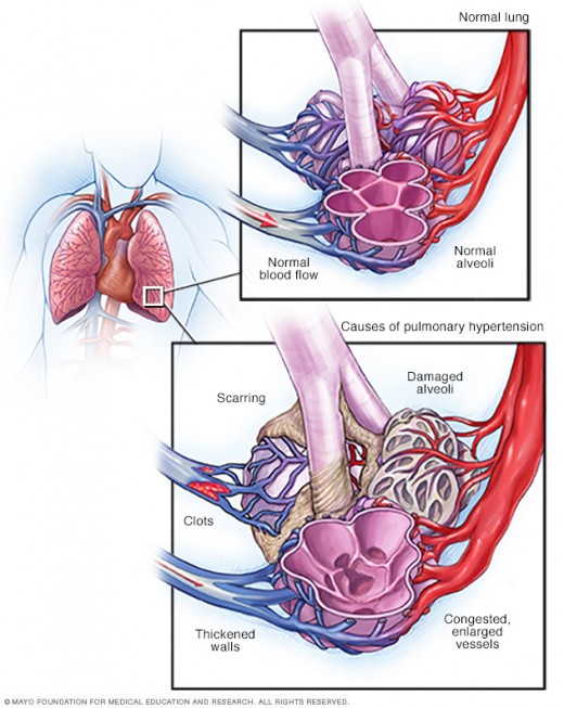 A comparison of normal lungs vs. PAH lungs.
