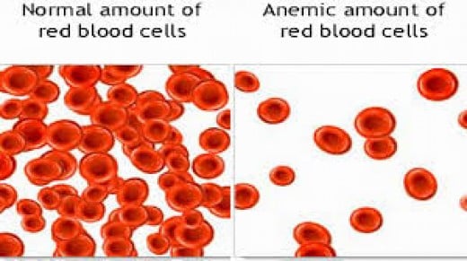 How to Prevent Symptoms of Anemia | HubPages