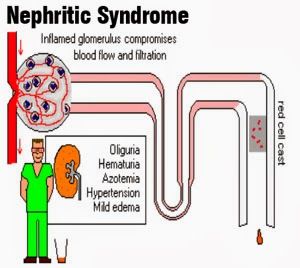 Nephrotic syndrome 