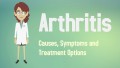 Arthritis: Causes, Symptoms and Treatments Options!