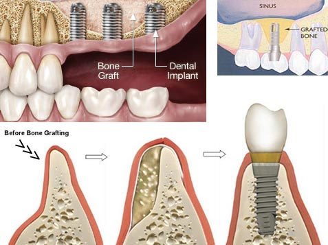 Bone Grafting in Dentisty