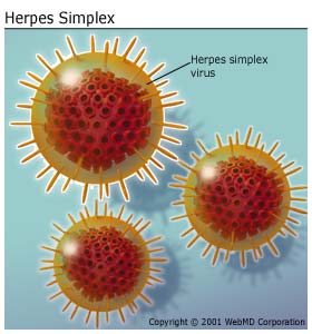 The Herpes Simplex Virus causing Cold Sores. 