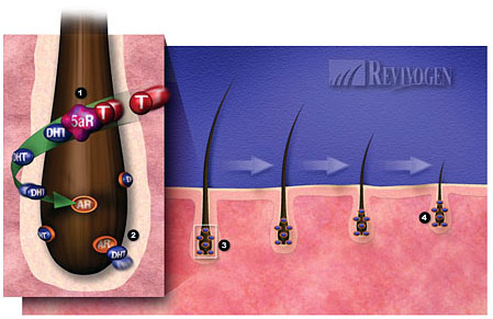 Without Revivogen - DHT causes shedding and miniaturization of the hair follicle