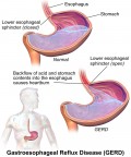 Heartburn, Acid Reflux and Gastro-Oesophageal Reflux Disease  (GERD)
