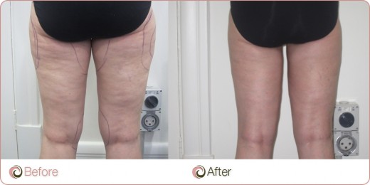 Banish Stubborn Cellulite For Good | HubPages