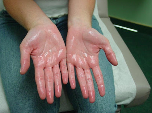 Sweaty palm syndrome 
