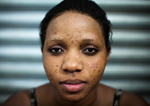 A young lady suffering from acne, as a result of skin bleaching.