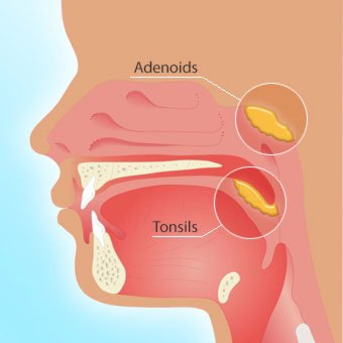 and throat Adult adenoids sore
