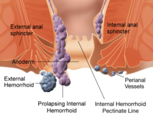 What to Expect From Hemorrhoid Removal Surgery What to Expect From Hemorrhoid Removal Surgery
