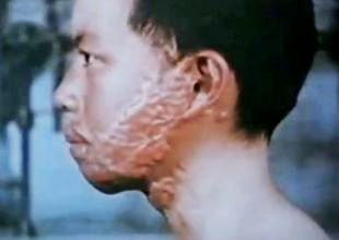 Child burn victim Hiroshima